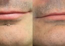 Novyado 2-in-1 Microneedle & Hydrocolloid Skin Patches product image 11