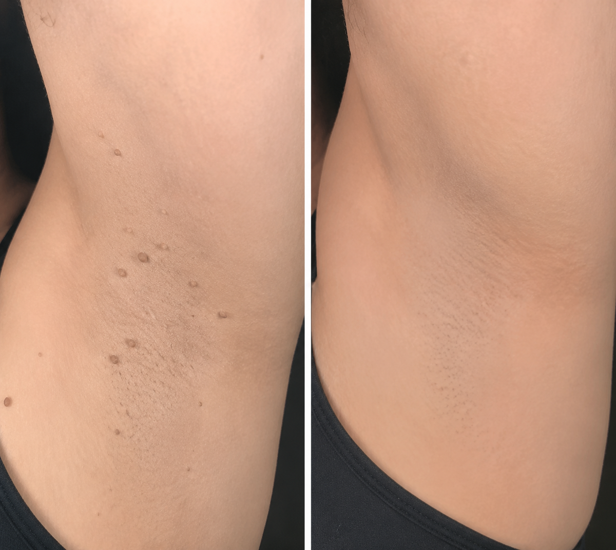 Novyado 2-in-1 Microneedle & Hydrocolloid Skin Patches product image 8