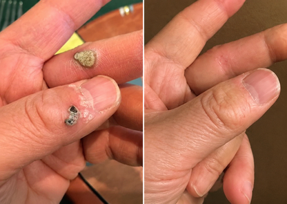 Novyado 2-in-1 Microneedle & Hydrocolloid Skin Patches product image 9